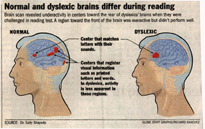 Dyslexia Brain Scan